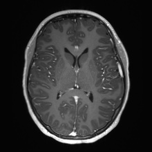 Cerebral cavernous venous malformation (Radiopaedia 70008-80021 Axial T1 C+ 39).jpg