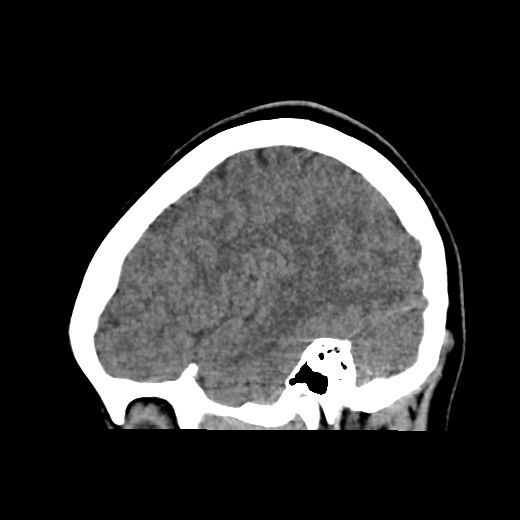 File:Cerebral cavernous venous malformation (Radiopaedia 70008-80022 C 13).jpg