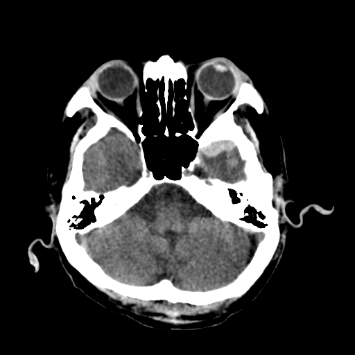 File:Cerebral contusions, subarachnoid hemorrhage and subdural hygromas (Radiopaedia 55399-61827 Axial non-contrast 10).png