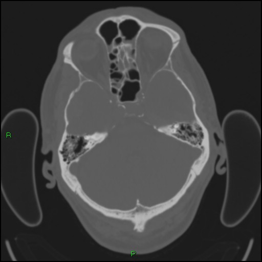 File:Cerebral contusions (Radiopaedia 33868-35039 Axial bone window 54).jpg