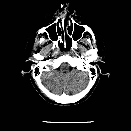 File:Cerebral edema (evolution in time) (Radiopaedia 19418-19441 non-contrast 18).jpg