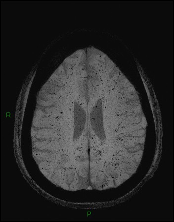 Cerebral fat embolism (Radiopaedia 35022-36525 Axial SWI 36).jpg