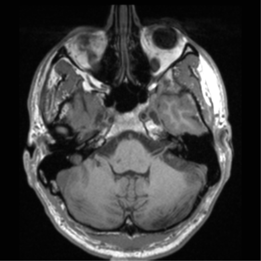 File:Cerebral hemorrhagic contusions- temporal evolution (Radiopaedia 40224-42757 Axial T1 18).png