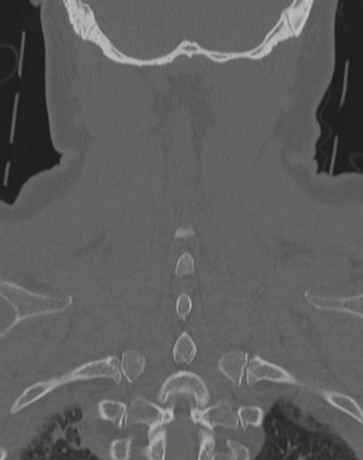 Cerebral hemorrhagic contusions and cervical spine fractures (Radiopaedia 32865-33841 Coronal bone window 63).jpg