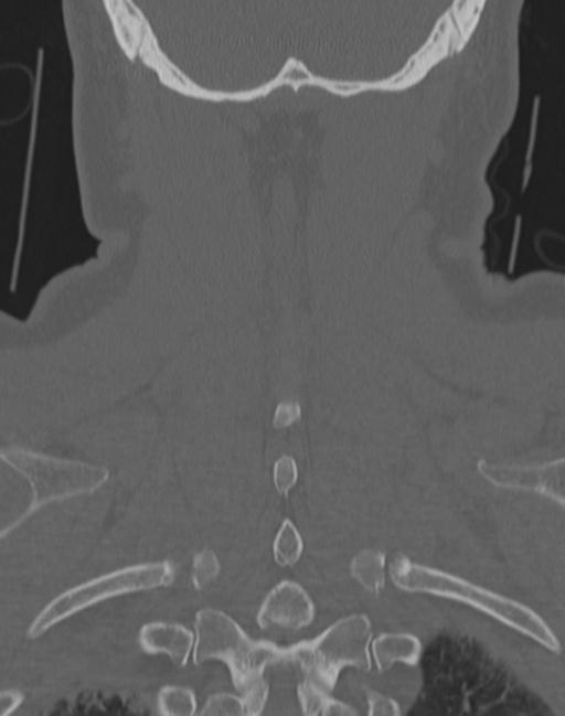 Cerebral hemorrhagic contusions and cervical spine fractures (Radiopaedia 32865-33841 Coronal bone window 65).jpg