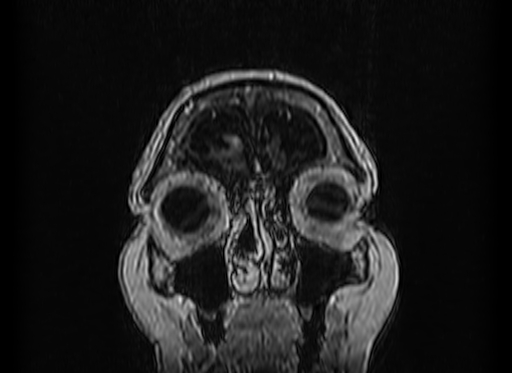 Cerebral metastases from lung cancer with amyloid angiopathy and cerebellopontine angle meningioma (Radiopaedia 74306-85191 Coronal T1 C+ 3).jpg