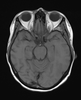 File:Cerebral metastasis (Radiopaedia 46744-51248 Axial T1 10).png