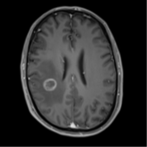 Cerebral metastasis - melanoma (Radiopaedia 54718-60954 Axial T1 C+ fat sat 34).png