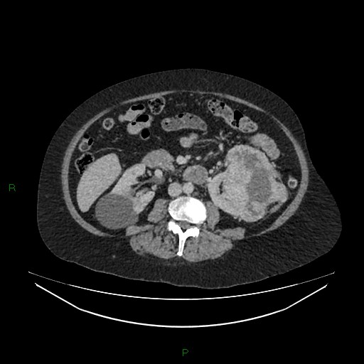 Cerebral metastasis from renal cell carcinoma (Radiopaedia 82306-96378 A 90).jpg
