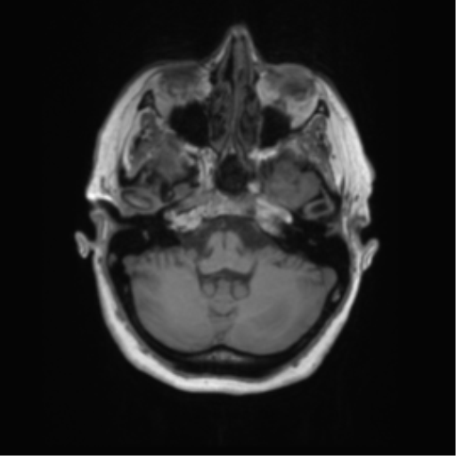 Cerebral metastasis mimicking glioblastoma (Radiopaedia 69155-78937 Axial T1 10).png