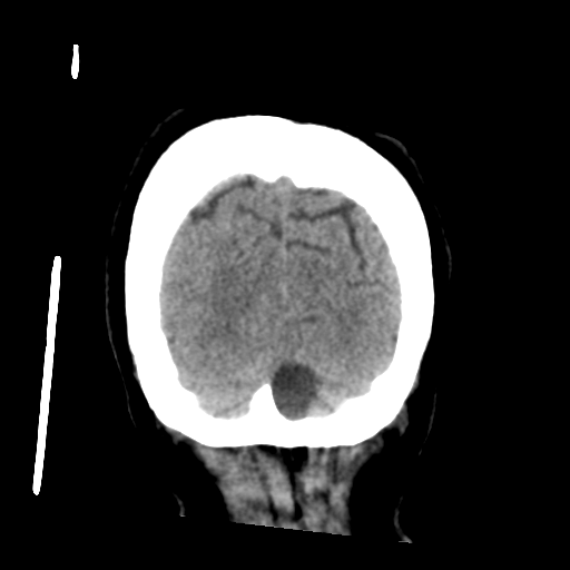 Cerebral metastasis to basal ganglia (Radiopaedia 81568-95412 Coronal non-contrast 58).png