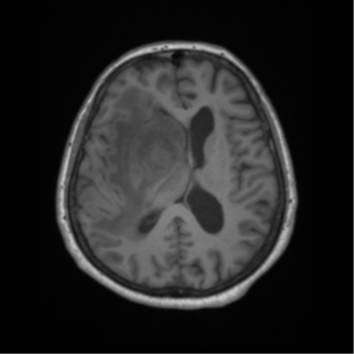 Cerebral metastasis to basal ganglia (Radiopaedia 81568-95413 Axial T1 42).png