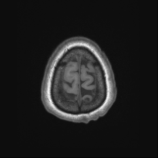 File:Cerebral metastasis to basal ganglia (Radiopaedia 81568-95413 Axial T1 69).png