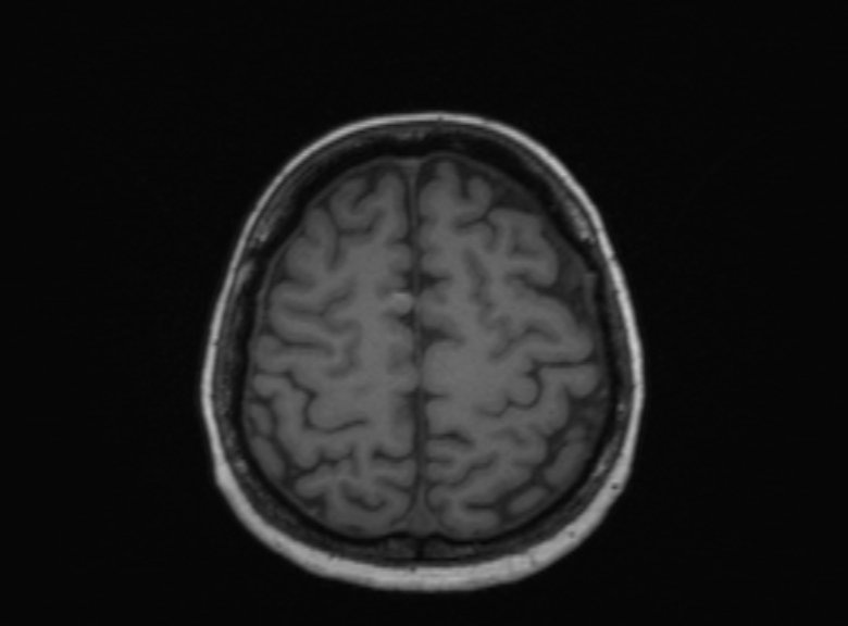Cerebral ring enhancing lesions - cerebral metastases (Radiopaedia 44922-48817 Axial T1 147).jpg