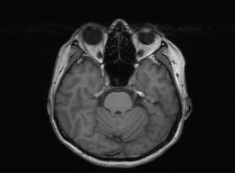 Cerebral ring enhancing lesions - cerebral metastases (Radiopaedia 44922-48817 Axial T1 280).jpg