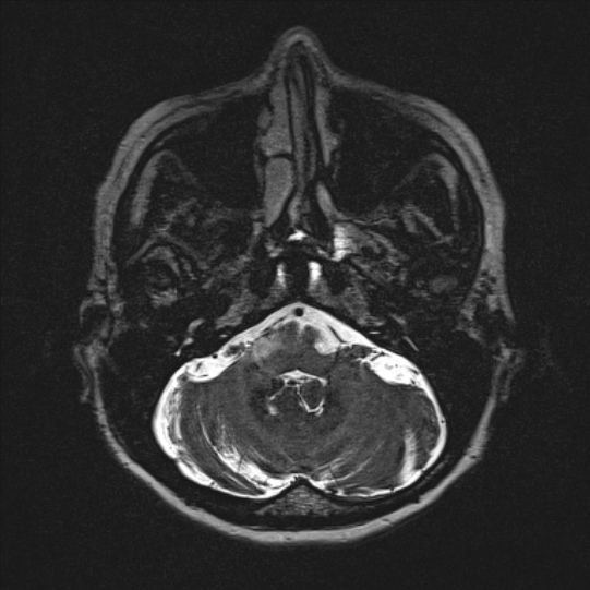 Cerebral ring enhancing lesions - cerebral metastases (Radiopaedia 44922-48817 F 23).jpg