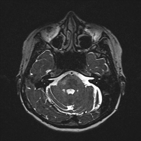 Cerebral ring enhancing lesions - cerebral metastases (Radiopaedia 44922-48817 F 41).jpg