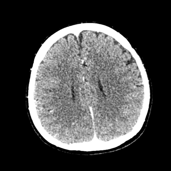 Cerebral ring enhancing lesions - cerebral metastases (Radiopaedia 44922-48818 B 186).jpg