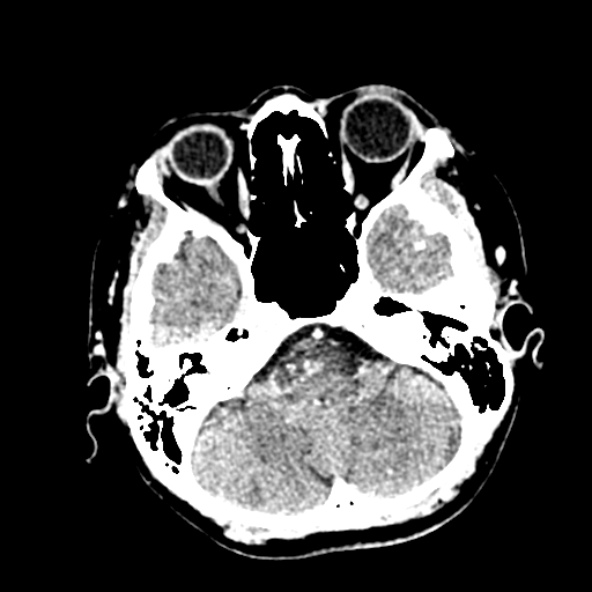 Cerebral ring enhancing lesions - cerebral metastases (Radiopaedia 44922-48818 B 69).jpg