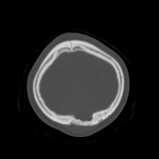 Cerebral tuberculosis with dural sinus invasion (Radiopaedia 60353-68018 Axial bone window 57).jpg