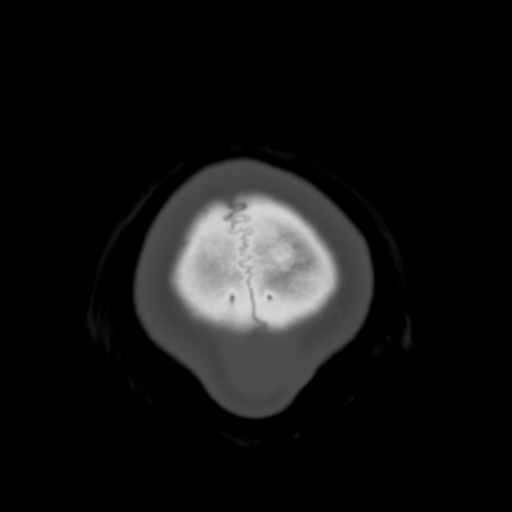 Cerebral tuberculosis with dural sinus invasion (Radiopaedia 60353-68018 Axial bone window 66).jpg