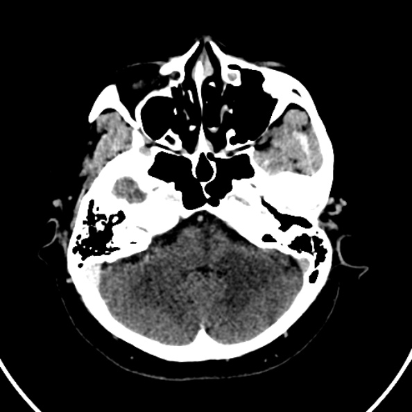 File:Cerebral venous hemorrhagic infarct from venous sinus thrombosis (Radiopaedia 55433-61883 Axial C+ delayed 117).jpg