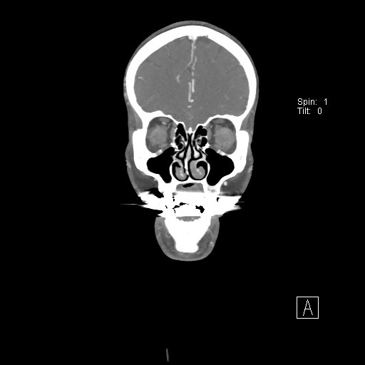 Cerebral venous infarction with hemorrhage (Radiopaedia 65343-74396 B 63).jpg