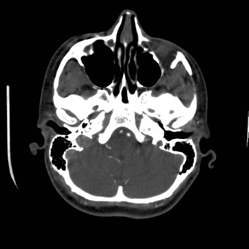 Cerebral venous sinus thrombosis (Radiopaedia 40619-43227 A 43).jpg