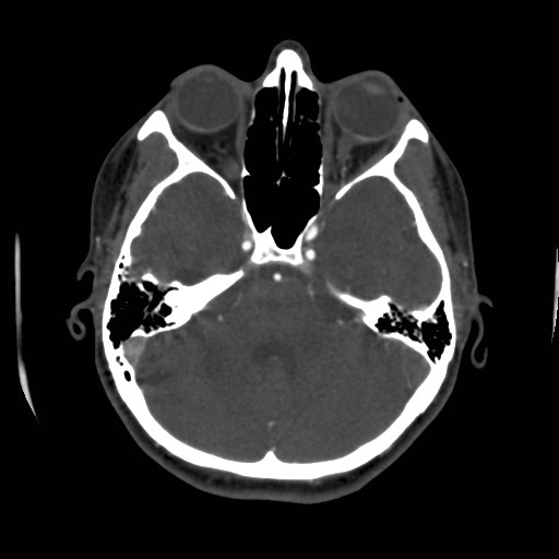 Cerebral venous sinus thrombosis (Radiopaedia 40619-43227 A 65).jpg
