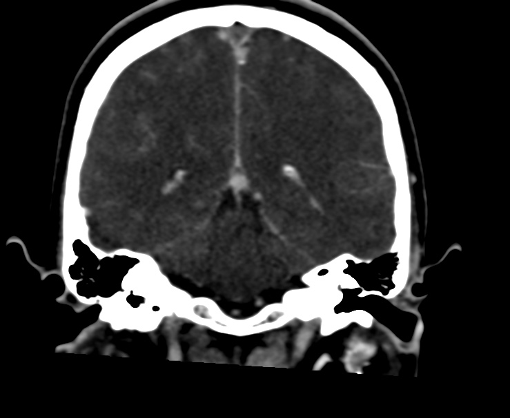 Cerebral venous sinus thrombosis (Radiopaedia 59224-66646 Coronal C+ delayed 49).jpg
