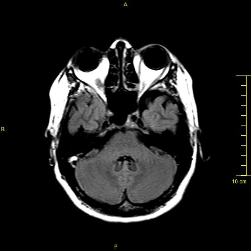 File:Cerebral venous thrombosis (Radiopaedia 23288-23351 Axial FLAIR 3).JPG
