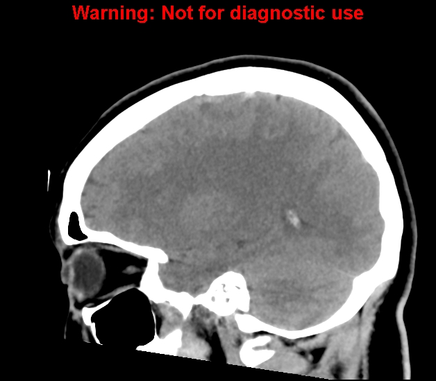 File:Cerebral venous thrombosis (Radiopaedia 37224-38992 B 11).jpg