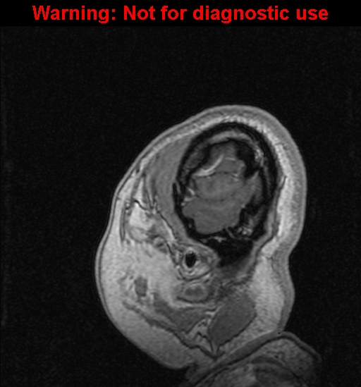 Cerebral venous thrombosis (Radiopaedia 37224-39208 Sagittal T1 C+ 142).jpg