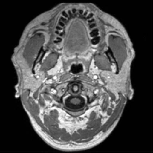 Cerebral venous thrombosis (Radiopaedia 38392-40469 Axial T1 C+ 2).png