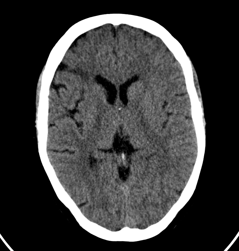 Cerebral venous thrombosis - CT only (Radiopaedia 41031-43778 Axial non-contrast 42).jpg