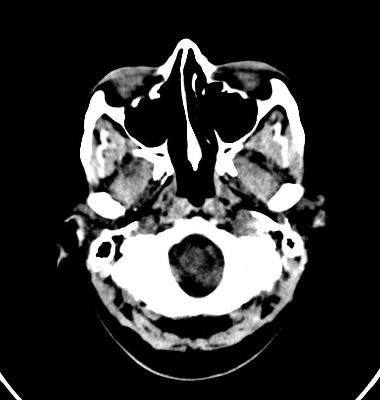 Cerebral venous thrombosis - CT only (Radiopaedia 41031-43778 Axial non-contrast 80).jpg