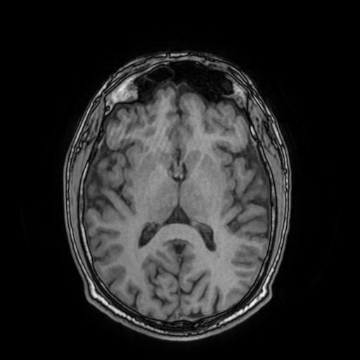 File:Cerebral venous thrombosis with secondary intracranial hypertension (Radiopaedia 89842-106957 Axial T1 98).jpg