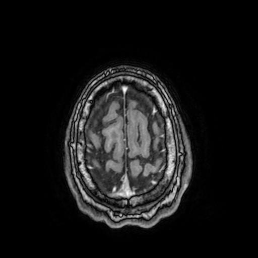 File:Cerebral venous thrombosis with secondary intracranial hypertension (Radiopaedia 89842-106957 Axial T1 C+ 150).jpg