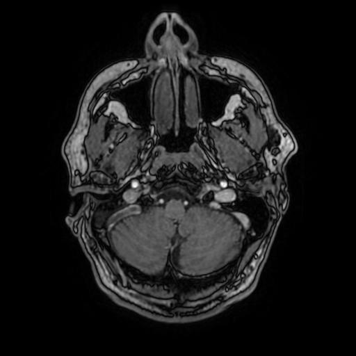 File:Cerebral venous thrombosis with secondary intracranial hypertension (Radiopaedia 89842-106957 Axial T1 C+ 41).jpg