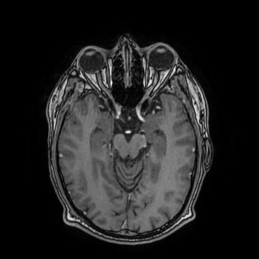 File:Cerebral venous thrombosis with secondary intracranial hypertension (Radiopaedia 89842-106957 Axial T1 C+ 79).jpg