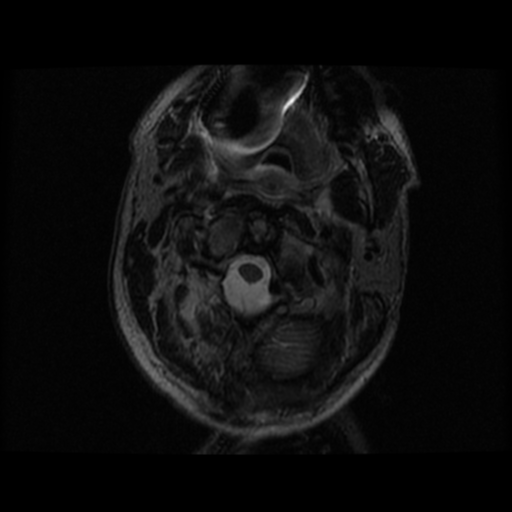 File:Cervical canal stenosis with cord compression (Radiopaedia 34114-35374 Axial T2 35).png