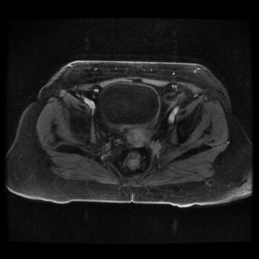 Cervical carcinoma (Radiopaedia 70924-81132 Axial T1 C+ fat sat 51).jpg