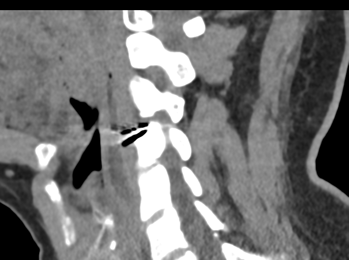 File:Cervical disc replacement (Radiopaedia 44025-47541 B 43).png