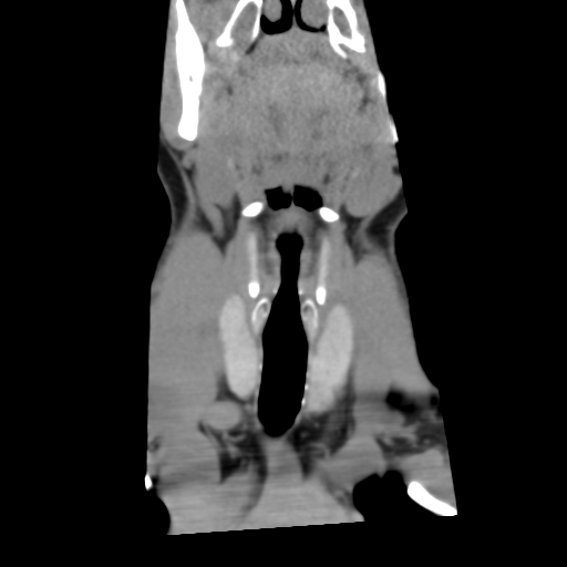 File:Cervical schwannoma (Radiopaedia 57979-64974 Coronal non-contrast 8).png