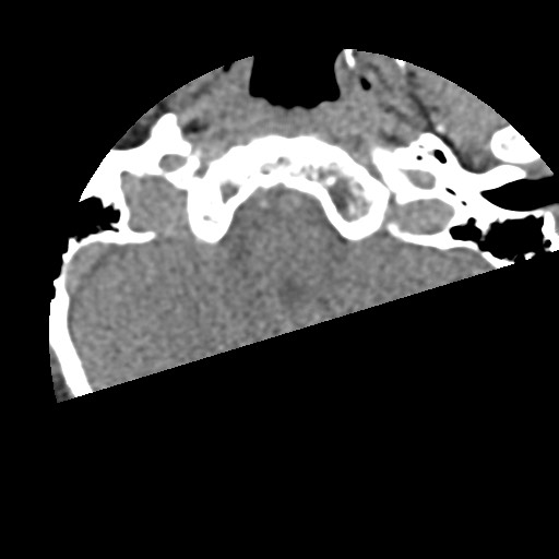 File:Cervical spinal neurofibroma in a patient with NF1 (Radiopaedia 58344-65464 Axial non-contrast 2).jpg