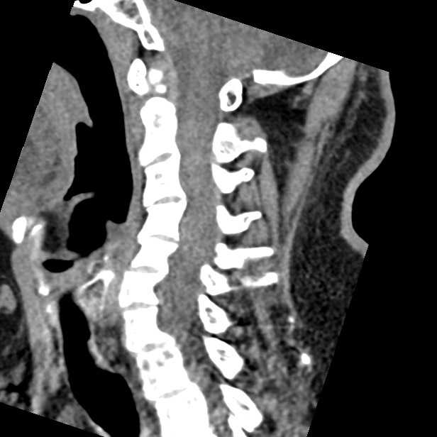 Cervical spinal neurofibroma in a patient with NF1 (Radiopaedia 58344-65464 C 30).jpg