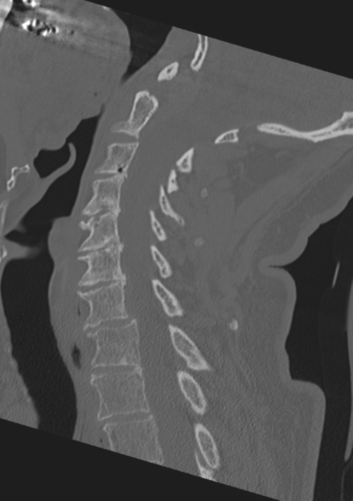 Cervical spine fractures with vertebral artery dissection (Radiopaedia 53296-59268 Sagittal bone window 30).png