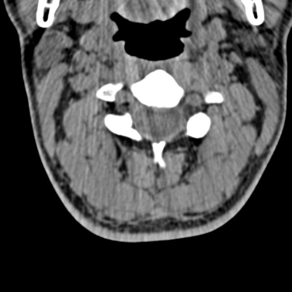 Cervical spondylodiscitis (Radiopaedia 28057-29489 Axial non-contrast 28).jpg