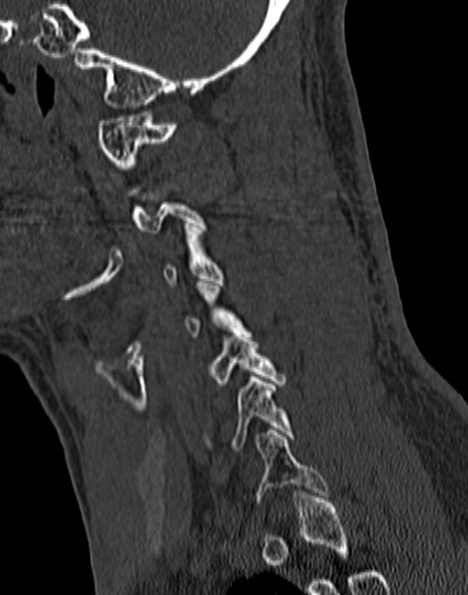 Cervical spondylodiscitis (Radiopaedia 28057-29489 Sagittal bone window 22).jpg
