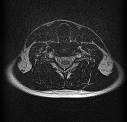 File:Cervical spondylodiscitis and calvarial hemangioma (Radiopaedia 64317-73104 Axial T2 17).jpg